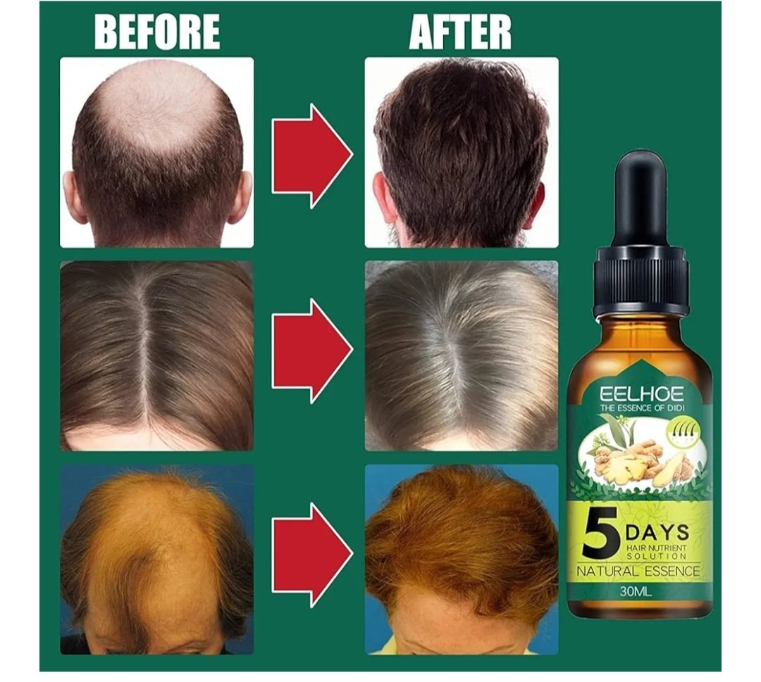 Eelhoe 5 Days Ginger Germinal Oil, (30ml) - Image 5